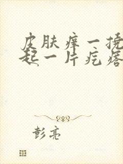 皮肤痒一挠就凸起一片疙瘩怎么治