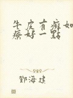 牛皮有癣如何治疗好一点