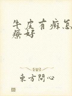 牛皮有癣怎么治疗好