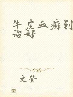 牛皮血癣到哪里治好