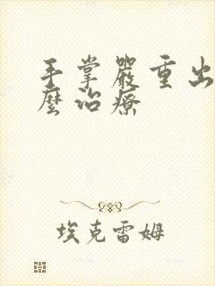 手掌严重出汗怎么治疗