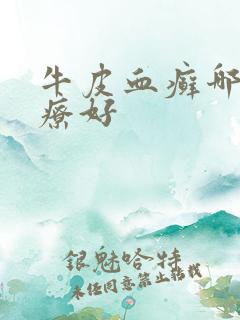 牛皮血癣哪里治疗好