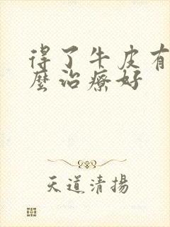 得了牛皮有癣怎么治疗好