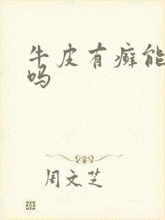 牛皮有癣能治疗吗