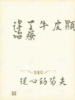 得了牛皮显如何治疗