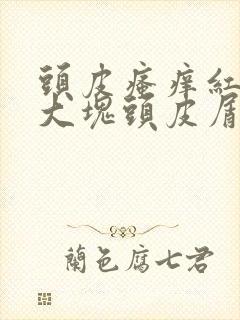 头皮瘙痒红肿,大块头皮屑