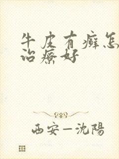 牛皮有癣怎么样治疗好