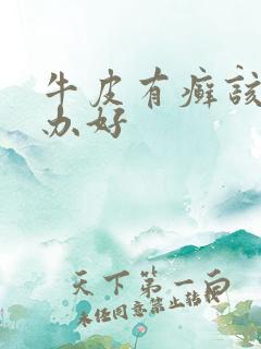 牛皮有癣该怎么办好