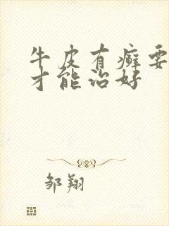 牛皮有癣要多久才能治好