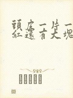 头皮一片一片发红还有大块头皮屑