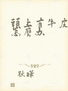 头上有牛皮血癣怎么办