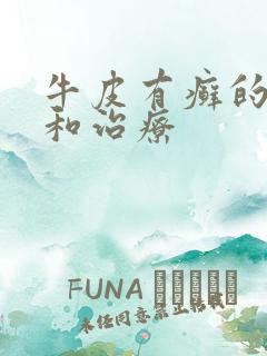 牛皮有癣的症状和治疗