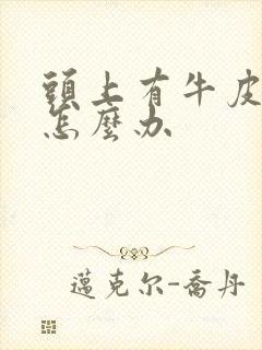 头上有牛皮血癣怎么办