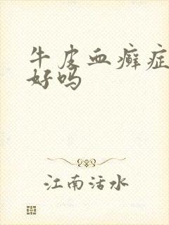 牛皮血癣症能治好吗