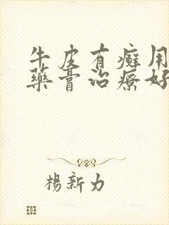 牛皮有癣用什么药膏治疗好的快些