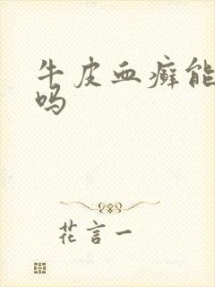 牛皮血癣能治疗吗