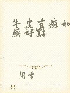 牛皮有癣如何治疗好点