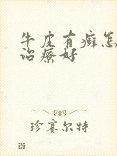 牛皮有癣怎么样治疗好