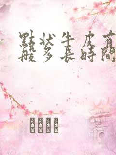 点状牛皮有癣一般多长时间可以好