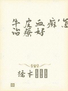 牛皮血癣`怎么治疗好