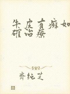 牛皮有癣如何正确治疗