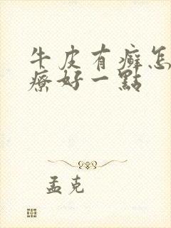 牛皮有癣怎么治疗好一点