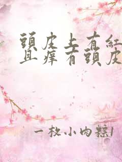 头皮上有红斑而且痒有头皮屑