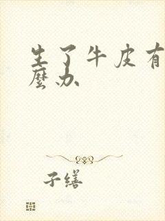 生了牛皮有癣怎么办