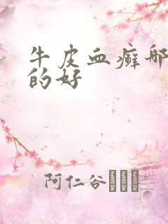 牛皮血癣哪里治的好