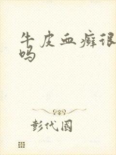 牛皮血癣很严重吗