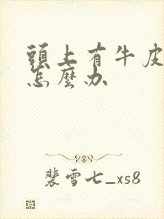 头上有牛皮血癣怎么办