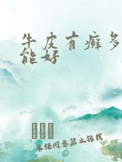 牛皮有癣多久才能好