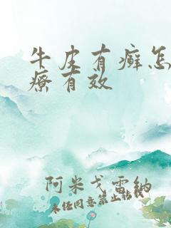 牛皮有癣怎么治疗有效