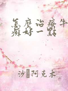 怎么治疗牛皮有癣好一点