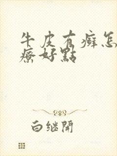 牛皮有癣怎么治疗好点