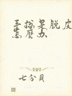 手总是脱皮开裂怎么办