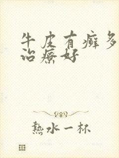 牛皮有癣多久能治疗好