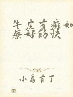 牛皮有癣如何治疗好的快