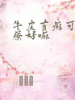 牛皮有癣可以治疗好嘛