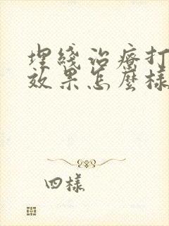 埋线治疗打呼噜效果怎么样