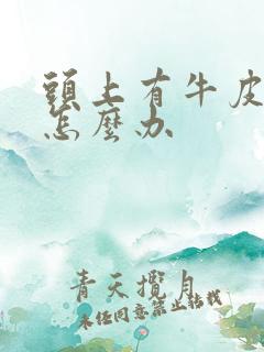 头上有牛皮有癣怎么办