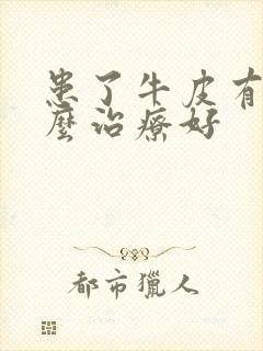 患了牛皮有癣怎么治疗好