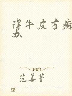 得牛皮有癣怎么办