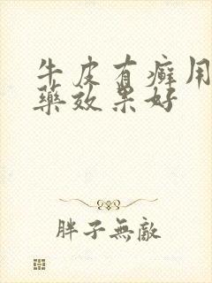 牛皮有癣用什么药效果好