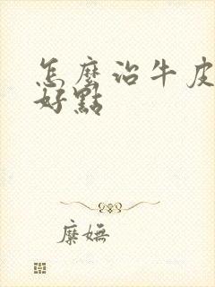 怎么治牛皮有癣好点