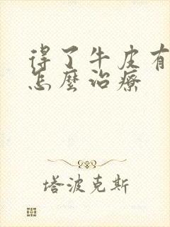 得了牛皮有癣该怎么治疗