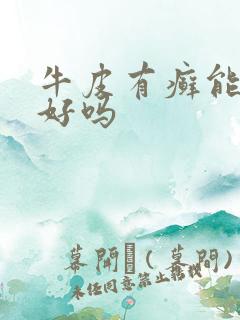 牛皮有癣能治得好吗