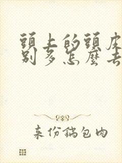 头上的头皮屑特别多怎么去除