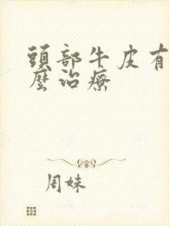 头部牛皮有癣怎么治疗