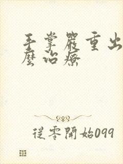 手掌严重出汗怎么治疗